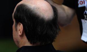 La fin de la calvitie